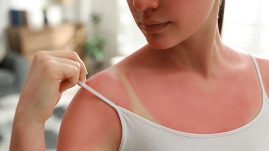 Using Goat Milk Soap for a Sunburn